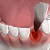 The Wisdom Tooth Impaction Category That Also Determine Wisdom Teeth Removal Cost