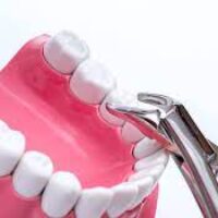 What Will Determine the Wisdom Teeth Removal Cost?