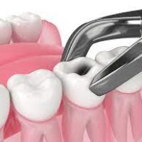 How to treat dental system after tooth extraction