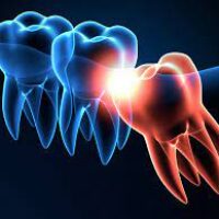 Wisdom teeth and dental health