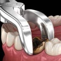 Why You Need to Choose Rational Wisdom Teeth Removal Cost?
