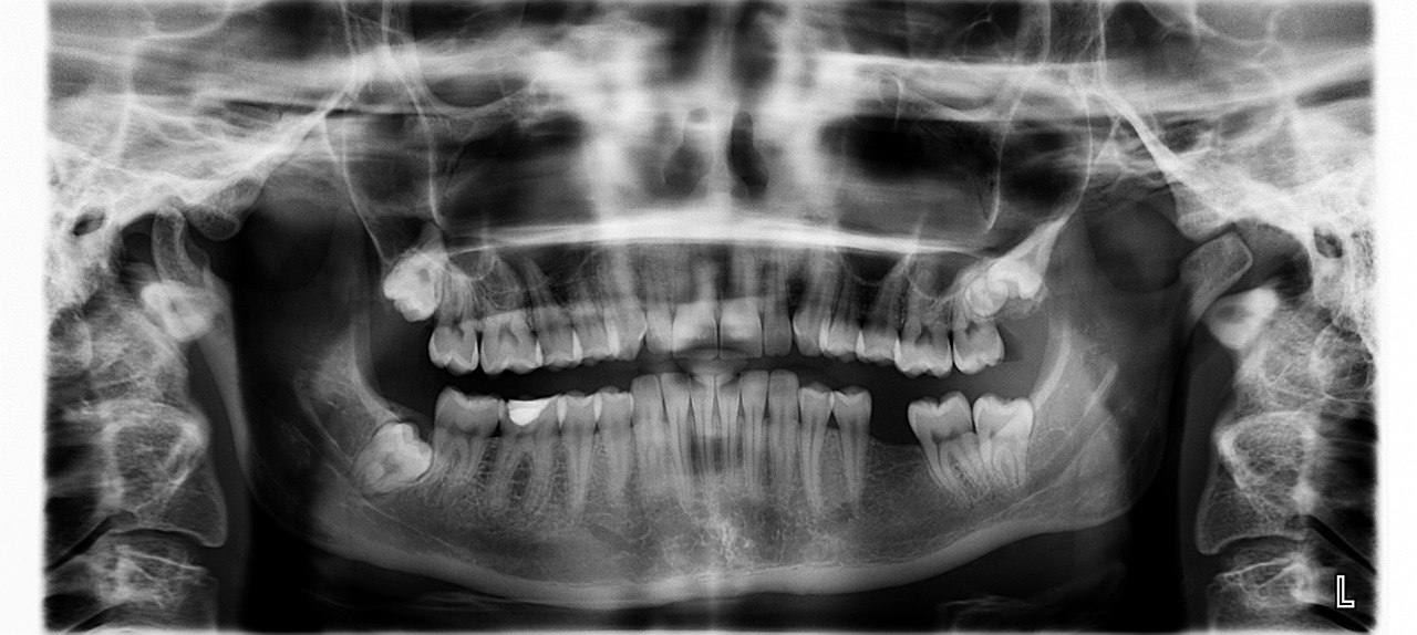 Impacted Wisdom Teeth's Effect on Headaches